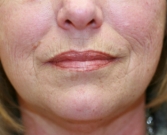 Feel Beautiful - Restylane in creases at sides of lips - Before Photo